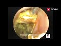 Cleaning of external auditory canal cholesteatoma and fungal otitis externa