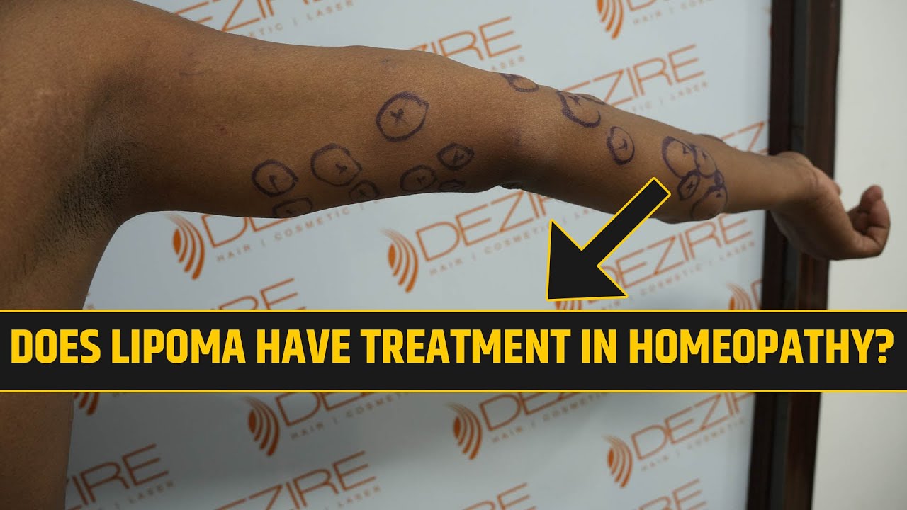 Multiple Lipoma Removal From Patient Arm Youtube