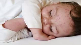 Varicela - Hablemos De Salud Infantil