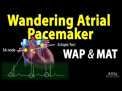 Wandering Atrial Pacemaker (WAP) & Multifocal Atrial Tachycardia (MAT)