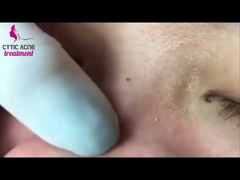 Cystic acne on the cheeks and nose