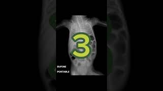 what is your diagnosis?#abdominal xrays case 51#trending #youtube #shortvideo #viral #shorts#short what is your diagnosis?#abdominal xrays case 51#trending #youtube #shortvideo #viral #shorts#short
