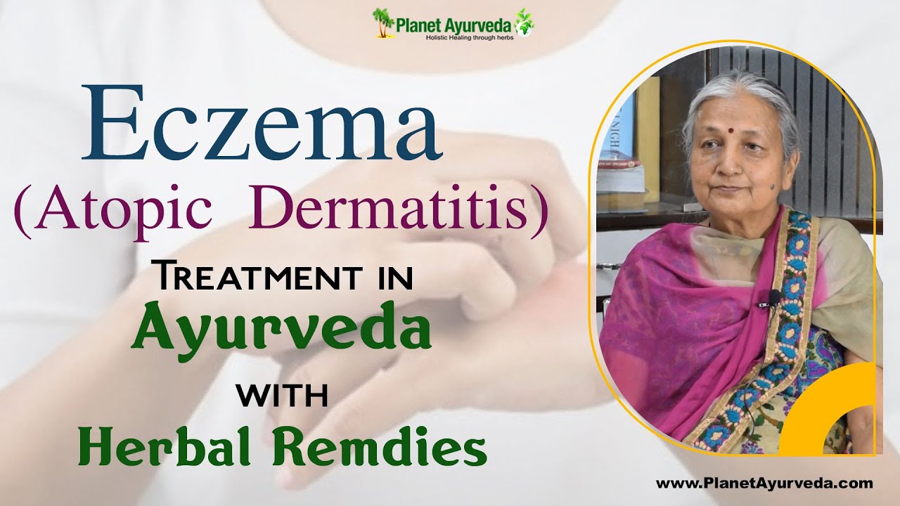 Watch Video Natural Cure of Eczema in Ayurveda - Real Testimonial