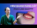 Viêm quanh răng cấp: Nguyên nhân & Điều trị hiệu quả 🦷