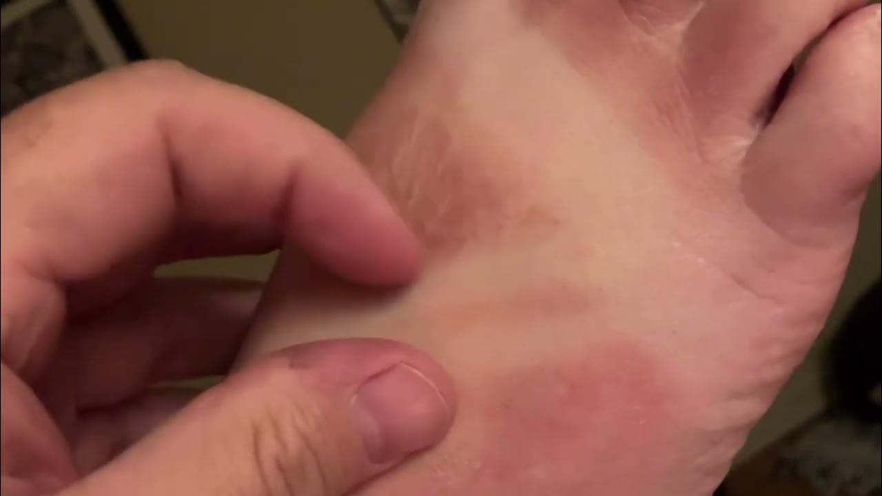 Foot Sunburn Foot Peel 1 YouTube