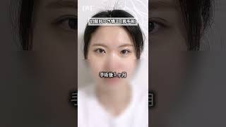 「取れた二重、切開二重でしっかり綺麗に！失敗ない二重✨」ビフォーアフター #切開二重｜韓国DM美容外科公式チャンネル