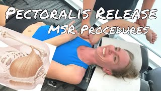 Pectoralis Release  MSR Procedures