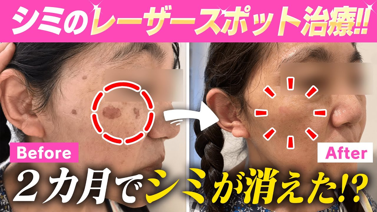 シミ治療】2ヶ月でこんなに綺麗に！?【ピコ秒レーザー治療】 - YouTube