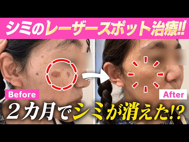 シミの治療: このシミをどう治す? シミの治療 このシミをどう治す
