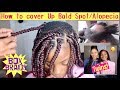 Update: How To cover Up Bald Spot/Alopecia/Box Braids/PROGRESS