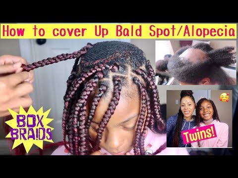 update:-how-to-cover-up-bald-spot/alopecia/box-braids/progress