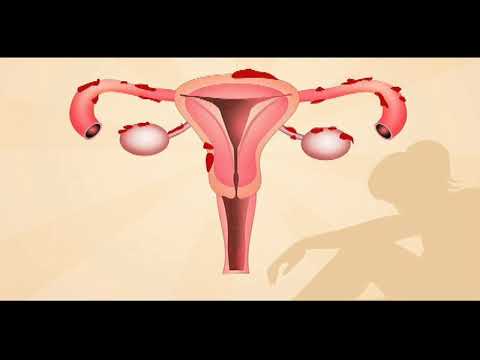 Video: Në endometriozën ku shkon gjaku?