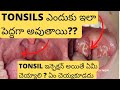 Tonsil Infection Causes,Symptoms,Remedies and Treatment In Children In Telugu | Throat infection
