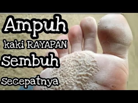 Video: Cara Menyembuhkan Luka Terbuka Dengan Cepat (dengan Gambar)