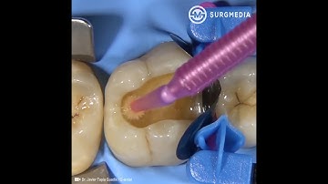 Step by Step Tooth Filling: Cusp Build-Up of a Molar