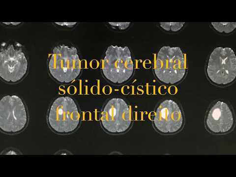 Vídeo: Tumors Cerebrals De Gos: Tumor Cerebral En Gossos