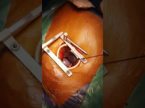 أثناء جراحة تغيير الصمام الميترالي بالمنظار من جرح جانبي بدون فتح عظمة القص