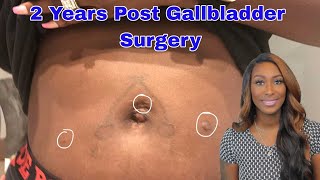 2 YEARS POST GALLBLADDER SURGERY