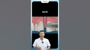 Ngỡ Ngàng Với Lợi Ích Cắt Phanh Môi Bám Thấp | Bác Sĩ Yên