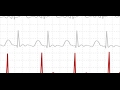 طريقة قراءة تخطيط القلب