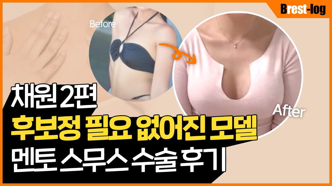 가슴성형 A→D컵 1달 후기 | 수술 당일~회복 전 과정 브이로그 | 윈느성형외과 - YouTube