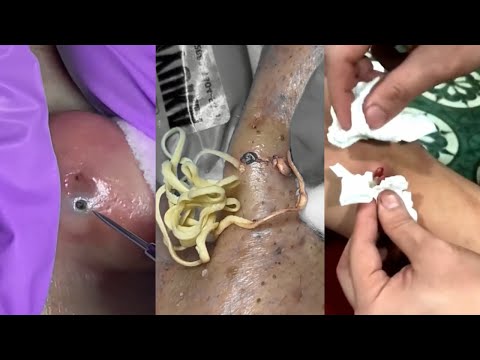 Crazy Popping Pimples And Removal Blackheads And Cyst - Best Pimple Popping Compilation Videos #4