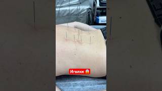 Лечим иголками. Рефлексотерапия             #pain #recovery