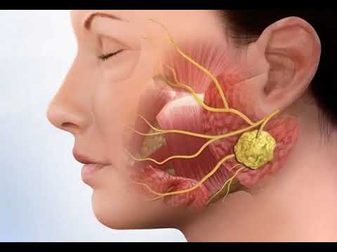 Заглоточный абсцесс