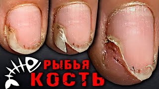 Рыбья КОСТЬ в НОГТЕ?🆘😱 ГНОЙ/Пустота под ногтем. СЮРПРИЗ под ГЕЛЬ-ЛАКОМ.ТРЕШ маникюр.ПРОТЕЗИРОВАНИЕ