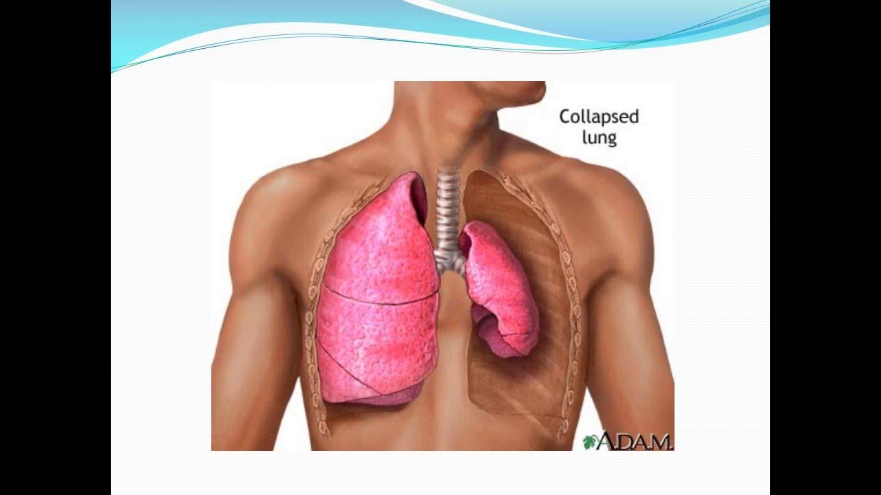 пневмоторакс реферат. травматический пневмоторакс клинические рекомендации. пневмоторакс дренирование плевральной полости. пневмоторакс классификация. рентген грудной клетки пневмоторакс.