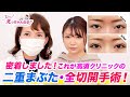 高須クリニックの二重まぶた・全切開手術！術後１ヶ月間密着しました