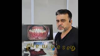 حالات الصنف الثالث التقويمي .class 3 malocclusion #toothpain #dentist #orthodontist #orthodontics