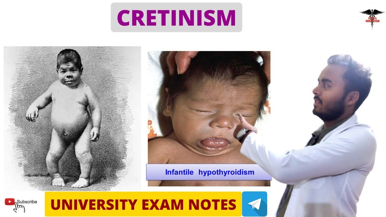Cretinism  || Hypothyroidism || Endocrine Physiology