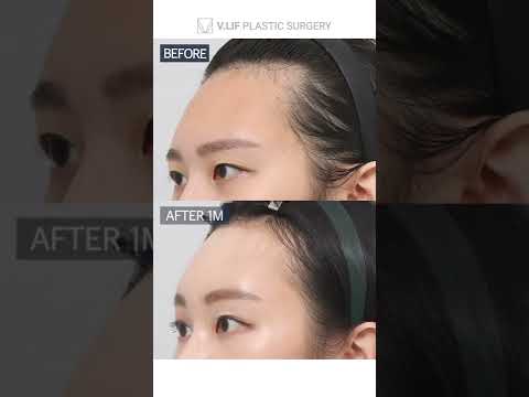 [B&A] Brow Lift