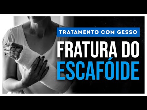 Vídeo: Qual é a sensação de um escafóide quebrado?