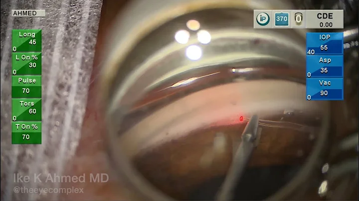 Combination MIGS for Glaucoma: Viscodilation, Trab...