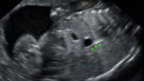 Early prenatal diagnosis of intraabdominal esophageal duplication cyst