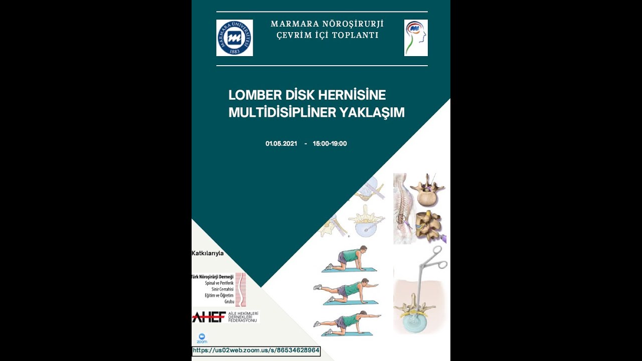 Lomber Disk Hernilerine Multidisipliner Yaklaşım