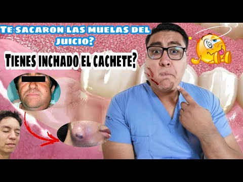 Vídeo: Hinchazón De Las Muelas Del Juicio