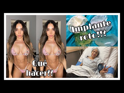 SE ME ROMPIÓ UN IMPLANTE!!!