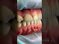 gum recession#teeth #dentist #dentalclinic #dental #dentalhealth #oralhealth #mouth #health #pain