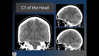 Polymethyl Methacrylate Embolic Cerebral Infarction