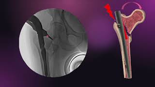 Wedge Effect In Trochanteric Fractures It Fractures Proximal Femur Fractures
