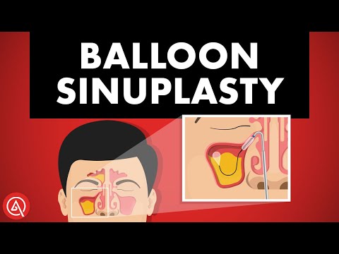 ADVENT Balloon Sinuplasty Webinar