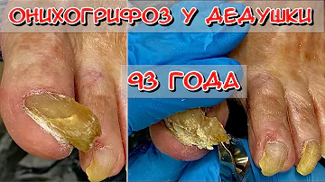 Онихогрифоз у дедушки / Толстый ноготь / Желтый ноготь / Ноготь растет в бок / Грибок ногтей
