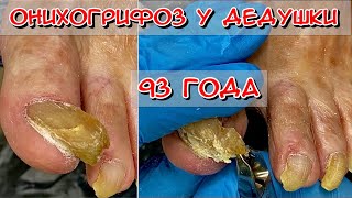 Онихогрифоз у дедушки / Толстый ноготь / Желтый ноготь / Ноготь растет в бок / Грибок ногтей