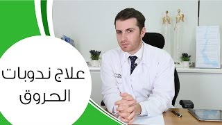 علاج ندوبات الحروق | مع الدكتور كوستي