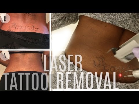 Watch My TRAMP STAMP Disappear!| Laser Tattoo Removal on Brown Skin | LaserAway