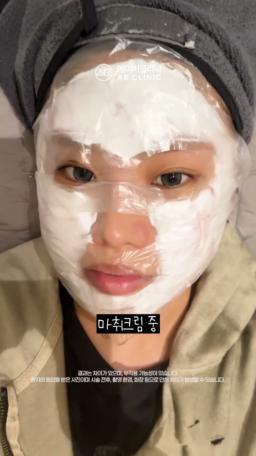 엠보 촘촘한 리쥬란!