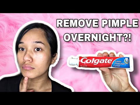HOW TO REMOVE PIMPLE OVERNIGHT USING TOOTHPASTE | PAANO MATANGGAL TAGYAWAT OR PIMPLE | Ashley Dee